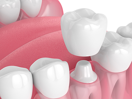 The image features a collection of artificial teeth with varying shades of pink and white, arranged in a row against a white background.