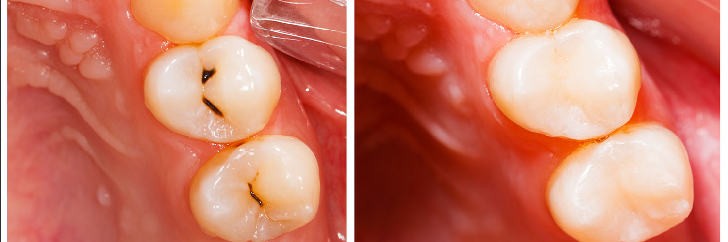 The image shows a close-up view of a person s mouth with crooked teeth, some of which appear to be missing enamel, and an open area revealing gum tissue and dental implants, with a focus on the lower front teeth and the tongue in the foreground.