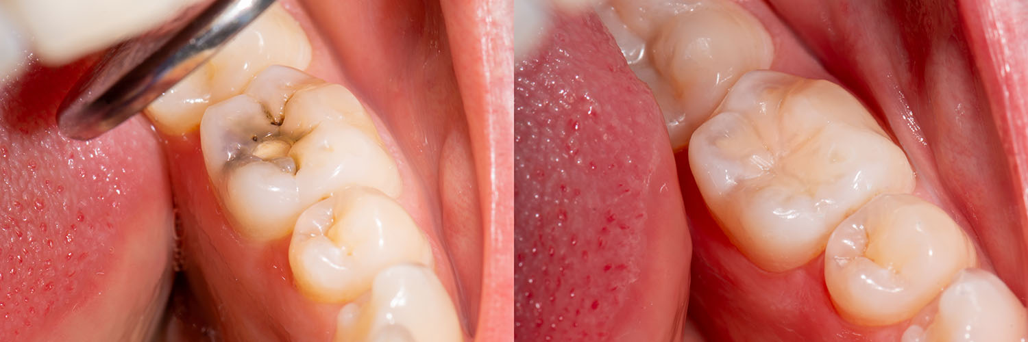 The image shows a close-up view of an open mouth with multiple teeth, some of which are missing or damaged, and a partial denture being held in place by a metal clasp.
