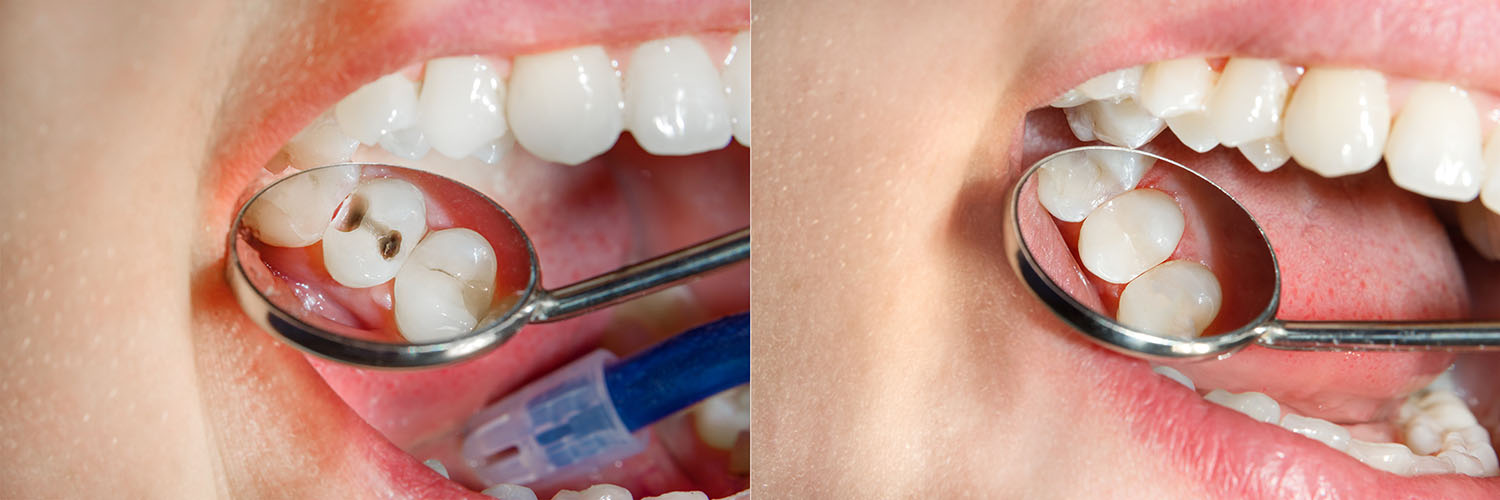 The image shows two photographs placed side by side  on the left, an open mouth with teeth and a tongue, and on the right, a close-up of a person s teeth being cleaned with a dental instrument, featuring a blue toothbrush.