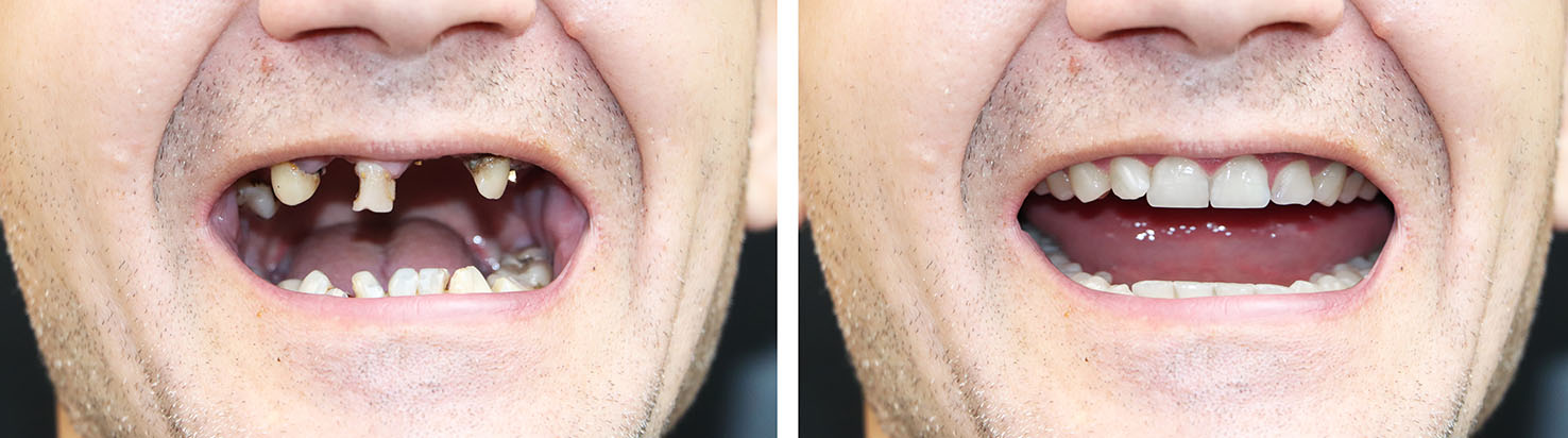 The image shows a person s face with an open mouth displaying multiple teeth, captured in a collage format with two different expressions of the same individual.