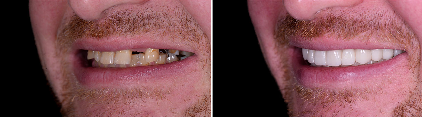 The image displays a split-screen comparison of a person s teeth before and after dental work, with the top half showing a mouth with crooked teeth and the bottom half showing a mouth with straightened teeth and a smile.